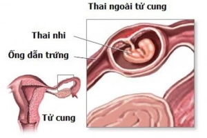 Khi nào phẫu thuật được sử dụng để điều trị thai ngoài tử cung?