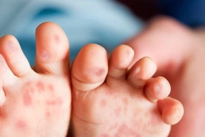 Khi trẻ bị bệnh tay chân miệng, cha mẹ cần làm gì?