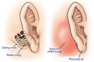 Không nghe được sau mổ viêm tai giữa phải làm sao?
