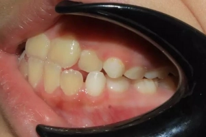 Khớp cắn ngược ở trẻ em phải điều trị thế nào?