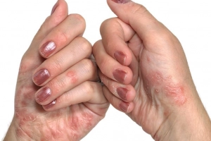 Kiểm soát bệnh vảy nến trên bàn tay