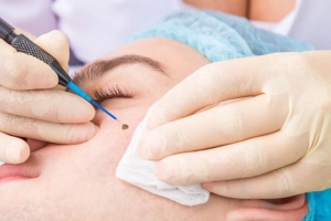 Kinh nghiệm chăm sóc da sau khi tẩy nốt ruồi