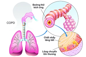 Kỳ 1: Bệnh phổi tắc nghẽn mãn tính có phải là hen suyễn do thuốc lá?