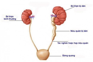 Kỹ thuật nào chẩn đoán hội chứng giãn đài thận?