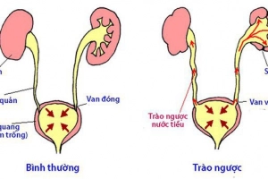 Kỹ thuật nào đánh giá mức độ trào ngược bàng quang niệu quản?