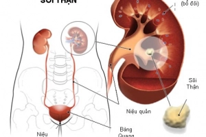 Kỹ thuật nào đánh giá tình trạng tiến triển của sỏi thận?
