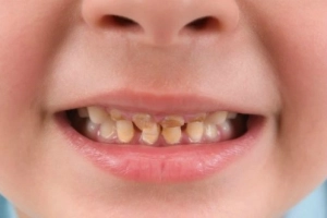 Làm gì khi bé bị mòn răng sữa?