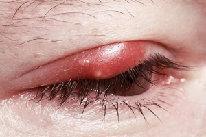 Làm gì khi mắt bị lẹo?