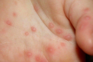 Làm gì khi nổi mụn nước ở lòng bàn tay bàn chân?