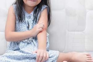Làm gì khi trẻ bị dị ứng thời tiết nổi mề đay?