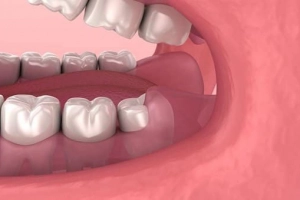 Làm gì với lợi thừa ở răng hàm?