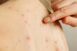 Làm sao để không bị lây thủy đậu?