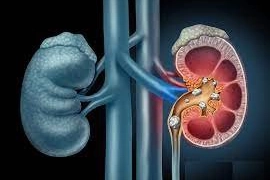 Làm thế nào để phát hiện sỏi thận chính xác nhất?