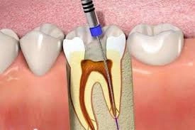 Lấy buồng tủy răng gây đau nhiều không?