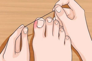 Lấy khóe móng chân bị sưng mủ có nguy hiểm?