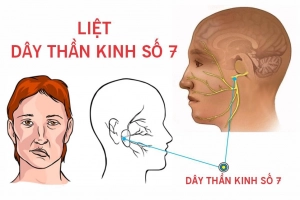Liệt dây thần kinh số 7 sau chấn thương sọ não có chữa được không?