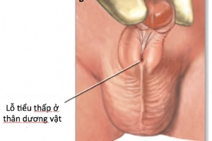 Lỗ tiểu thấp ở tuổi 22 có điều trị được không?