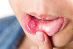 Loét canker (lở miệng) ở trẻ nhỏ có nguy hiểm?
