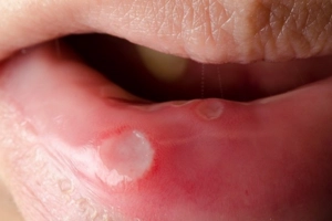 Loét miệng ở bệnh nhân HIV