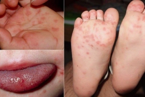 Lưu ý khi áp dụng biện pháp dân gian chăm sóc trẻ bị tay chân miệng