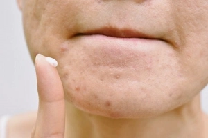 Lưu ý khi chọn thuốc trị mụn cho da dầu