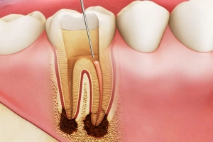 Lưu ý khi chữa tủy răng số 6 và 7