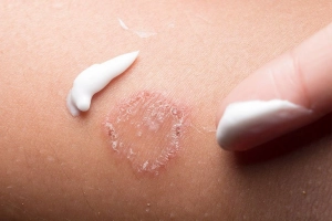 Lưu ý khi dùng thuốc điều trị hắc lào