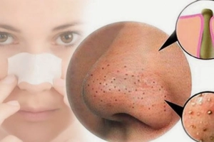 Lưu ý khi dùng thuốc trị mụn đầu đen ở mũi