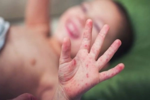 Lưu ý sử dụng thuốc bôi ngoài da cho người bị tay chân miệng
