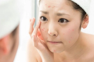 Lưu ý trong phác đồ điều trị mụn trứng cá bằng Isotretinoin