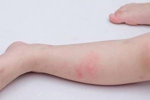 Lý do khiến trẻ bị nổi mẩn đỏ như muỗi đốt