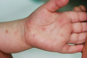 Mã ICD bệnh tay chân miệng và đặc điểm sinh lý của bệnh