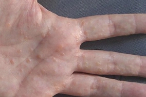Mắc tổ đỉa kèm nổi mụn nước đỏ khắp người điều trị thế nào?