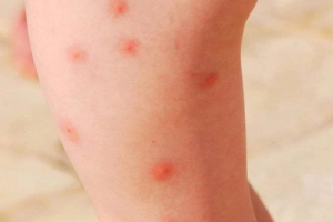 Mẩn ngứa lan rộng từ đùi xuống cổ chân có sao không?