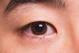 Mắt đỏ kèm mụn nhọt trong mắt dấu hiệu bệnh gì?