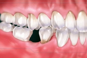 Mất răng số 7 có niềng răng được không?