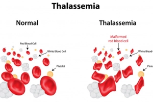 Mẹ mang gen Thalassemia khi sinh con có sao không?