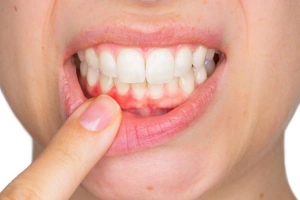 Mẹo trị dứt điểm các bệnh viêm lợi ngay tại nhà