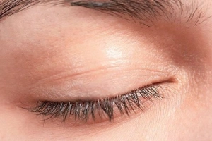 Mi dưới mắt không co giãn được sau cấy mi có nguy hiểm không?