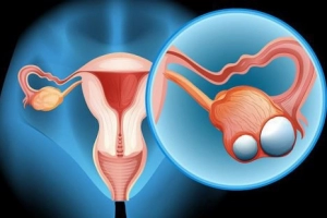 Mổ nội soi - giải pháp tốt cho người bệnh ung thư buồng trứng giai đoạn sớm