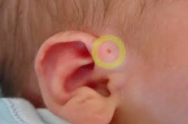 Mổ rò luân nhĩ biến chứng áp xe có gây tê không?
