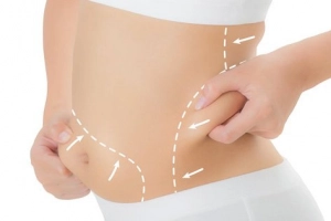 Mỡ thừa có tích tụ trở lại sau khi hút mỡ bụng không?