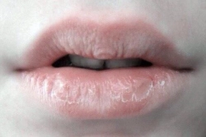 Môi khô bong da lâu năm điều trị thế nào?