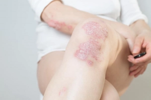 Mối liên hệ giữa bệnh vẩy nến và hút thuốc