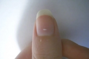 Móng tay có đốm trắng là bệnh gì?