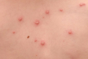 Mụn nước: Nguyên nhân và cách điều trị