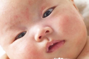 Mụn sữa ở trẻ sơ sinh có tự biến mất không?