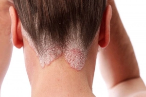 Nấm da đầu kèm rụng tóc phải làm sao?