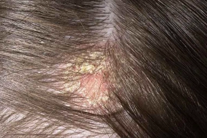 Nấm đầu kèm ngứa da đầu nên bôi thuốc gì?