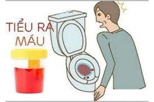 Nam giới đi tiểu ra máu là bệnh gì?